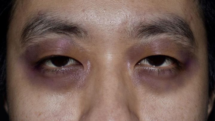 Kenali Raccoon Eyes, Seperti Dibogem tapi Ini Tanda Medis Serius